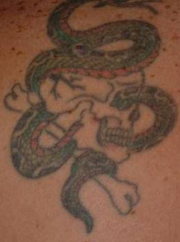 Tattoo Removal - Case #3 Before