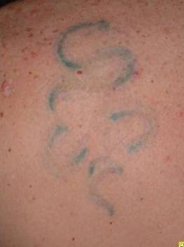 Tattoo Removal - Case #5 After