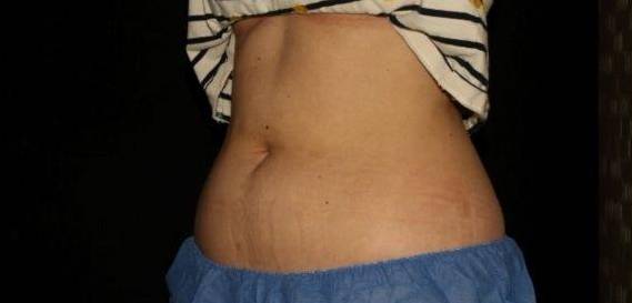 Coolsculpting - Case #10 Before