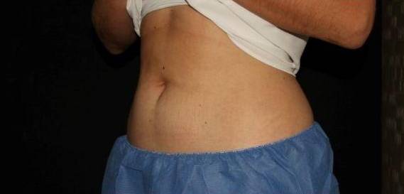 Coolsculpting - Case #10 After
