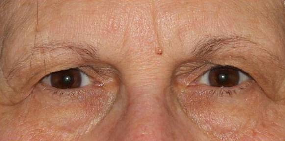 Upper Blepharoplasty - Case #1 Before