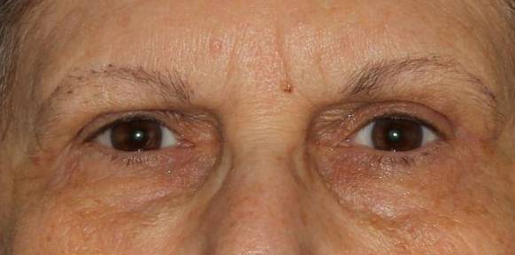 Upper Blepharoplasty - Case #1 After