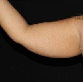 Upper Arm Liposuction - Case #1 Before