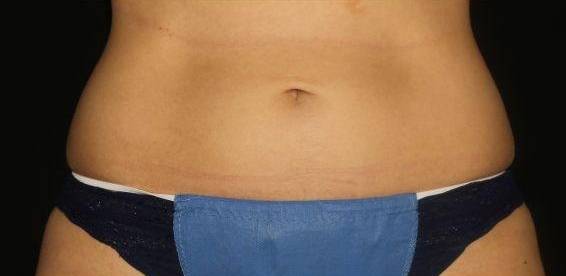 Coolsculpting - Case #7 After