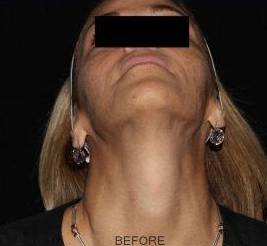 Filler Face - Case #1 Before