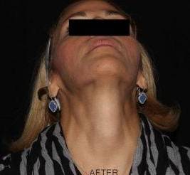 Filler Face - Case #1 After