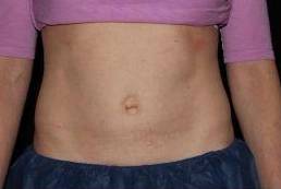 Coolsculpting - Case #2 After