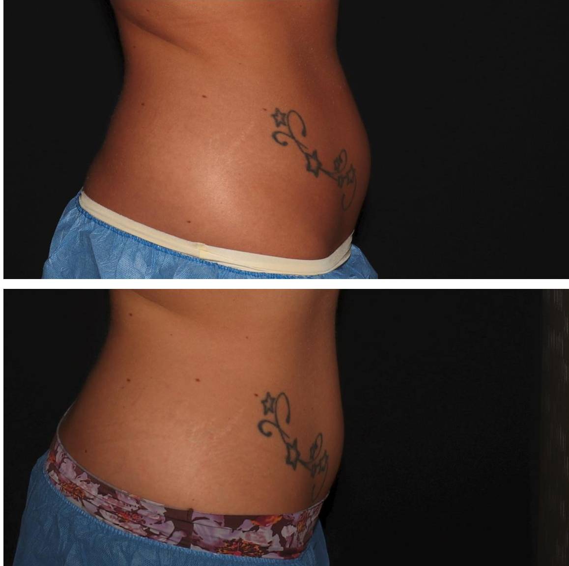 Coolsculpting - Case #5 