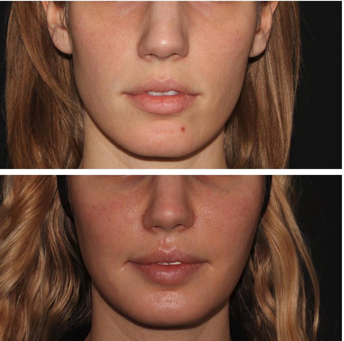 Filler Face - Case #3 