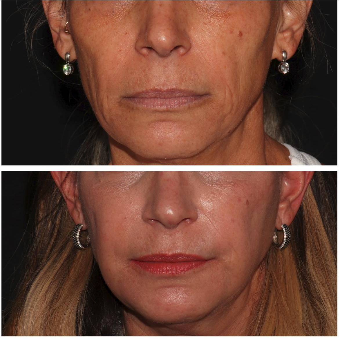 Filler Face - Case #4 