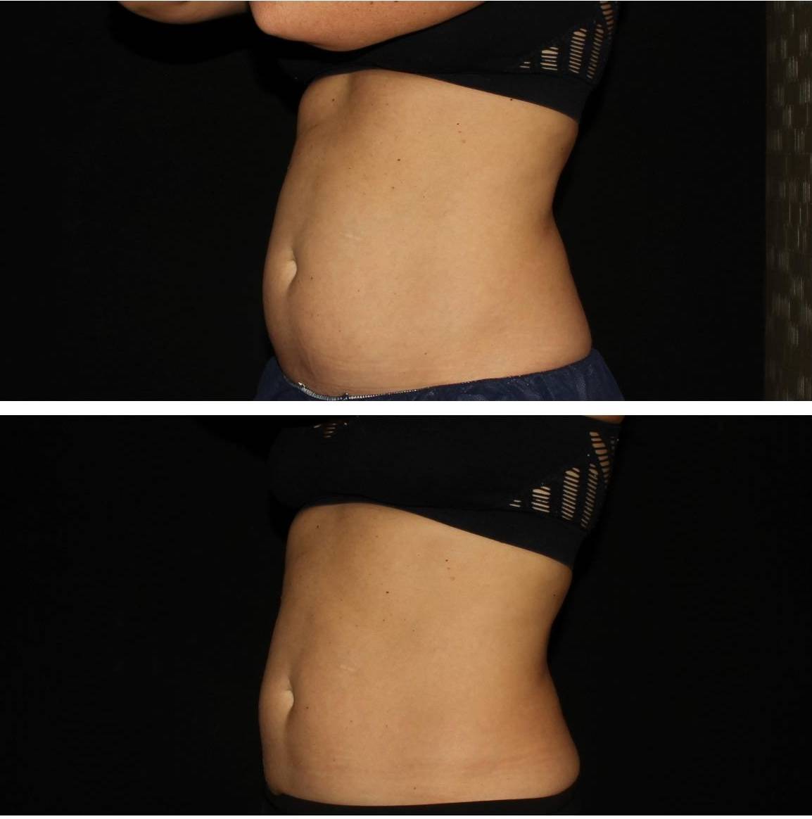 Coolsculpting - Case #4 