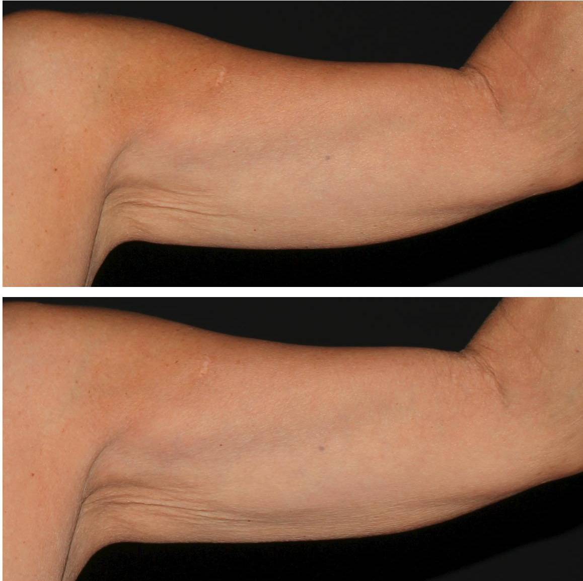 Coolsculpting - Case #3 