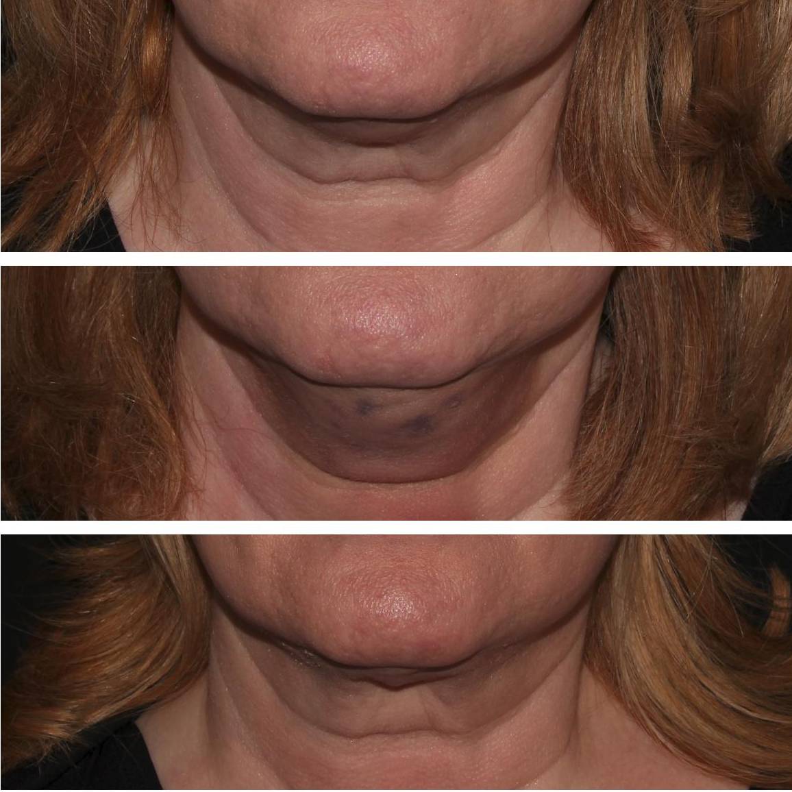 Kybella - Case #3 