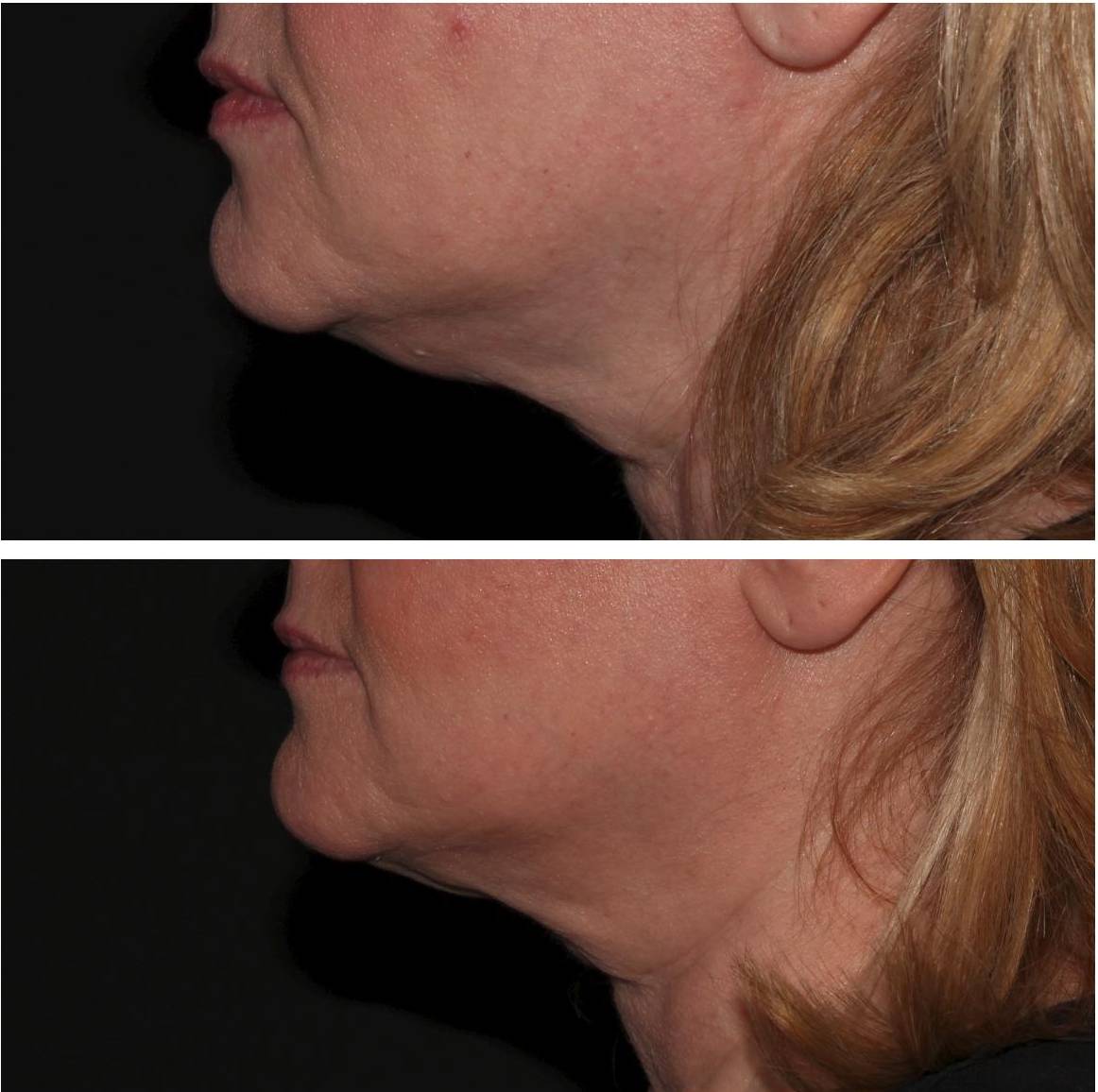 Kybella - Case #4 