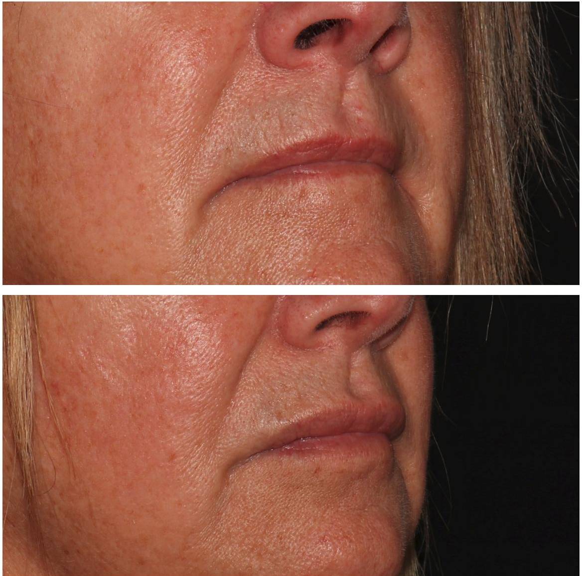 Filler Lips - Case #5 
