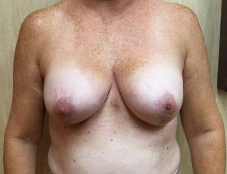 Breast Augmentation - Case #4 After