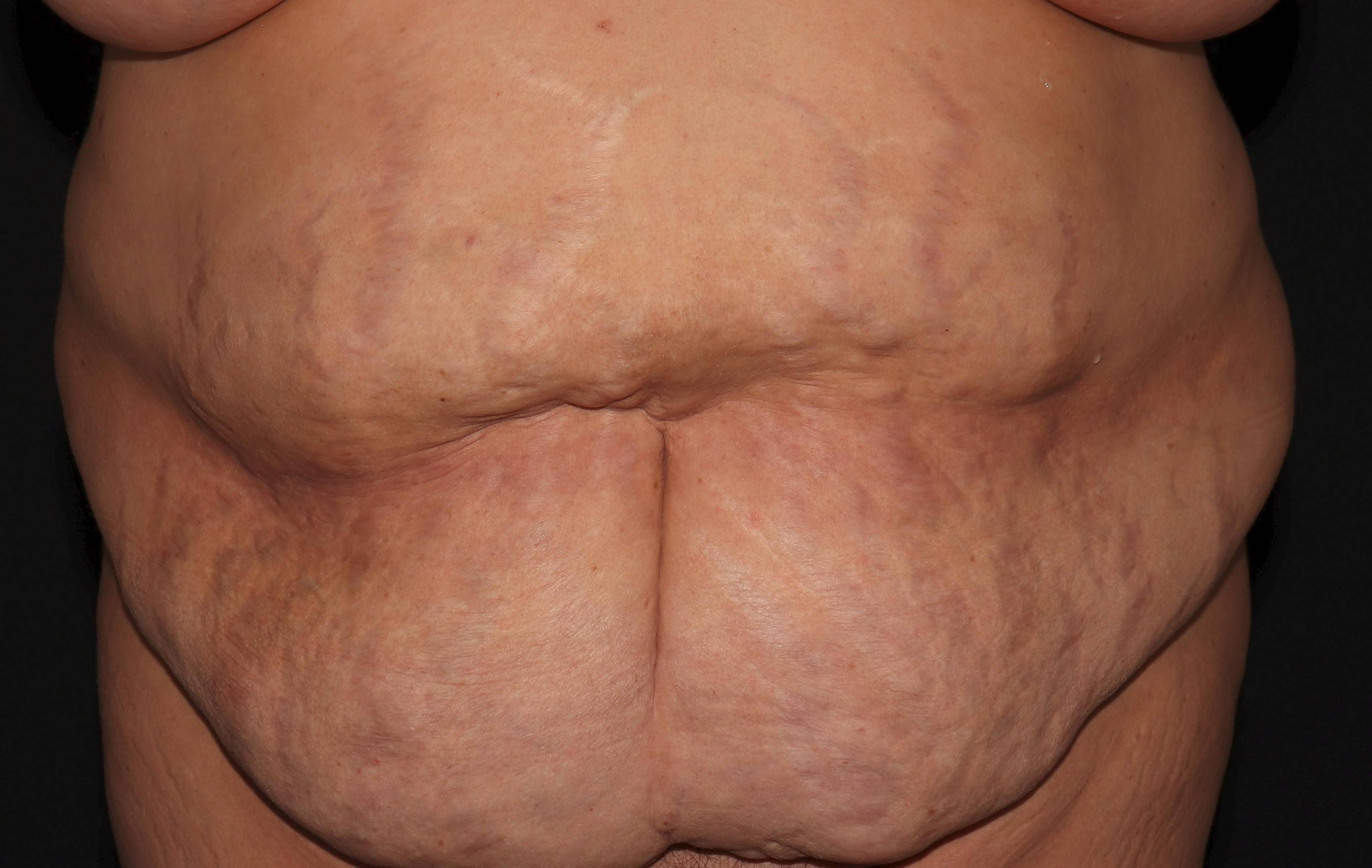 Abdominoplasty - Case #3 Before