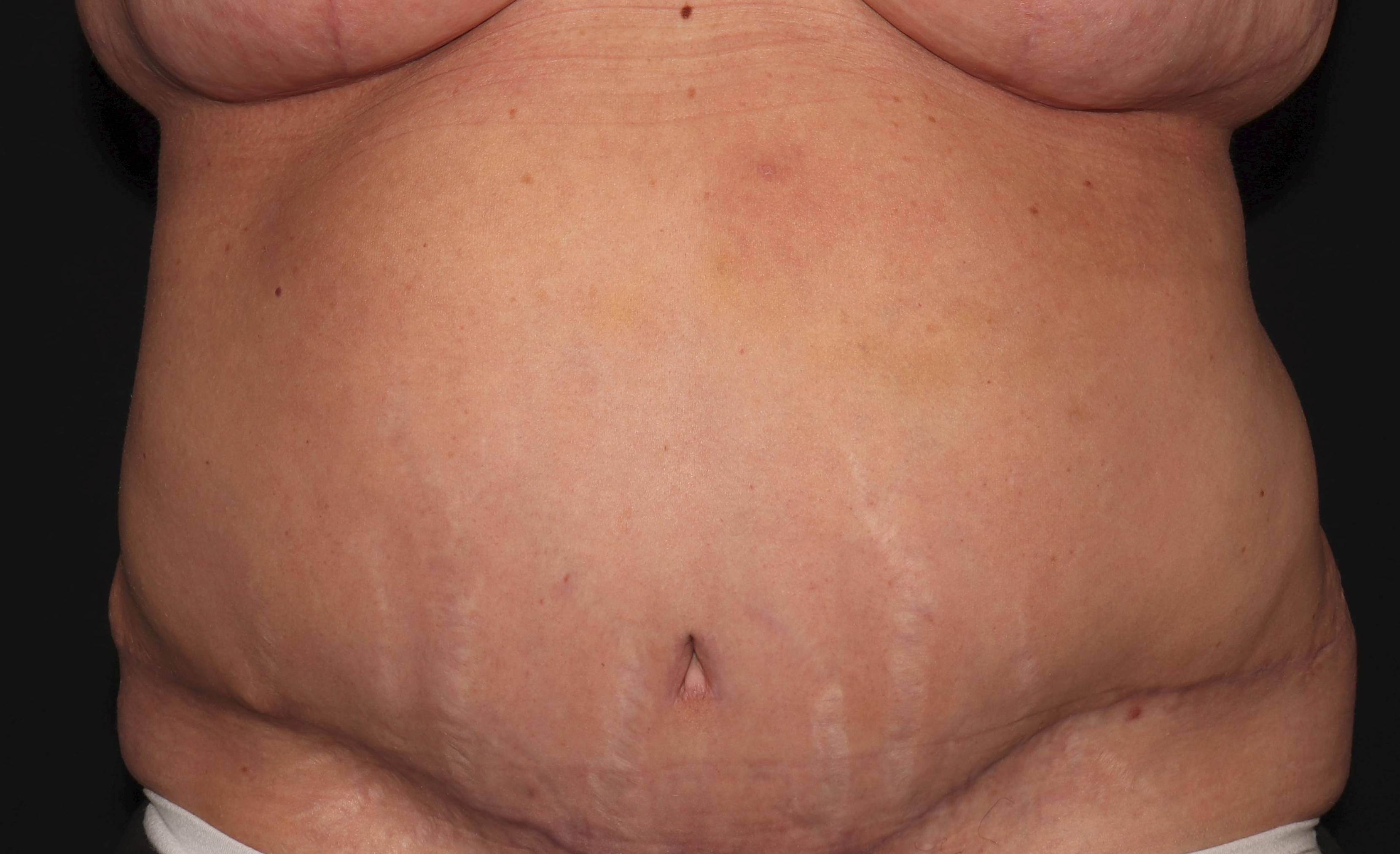 Abdominoplasty - Case #3 After