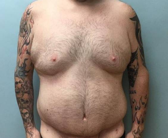 Abdominoplasty - Case #5 After