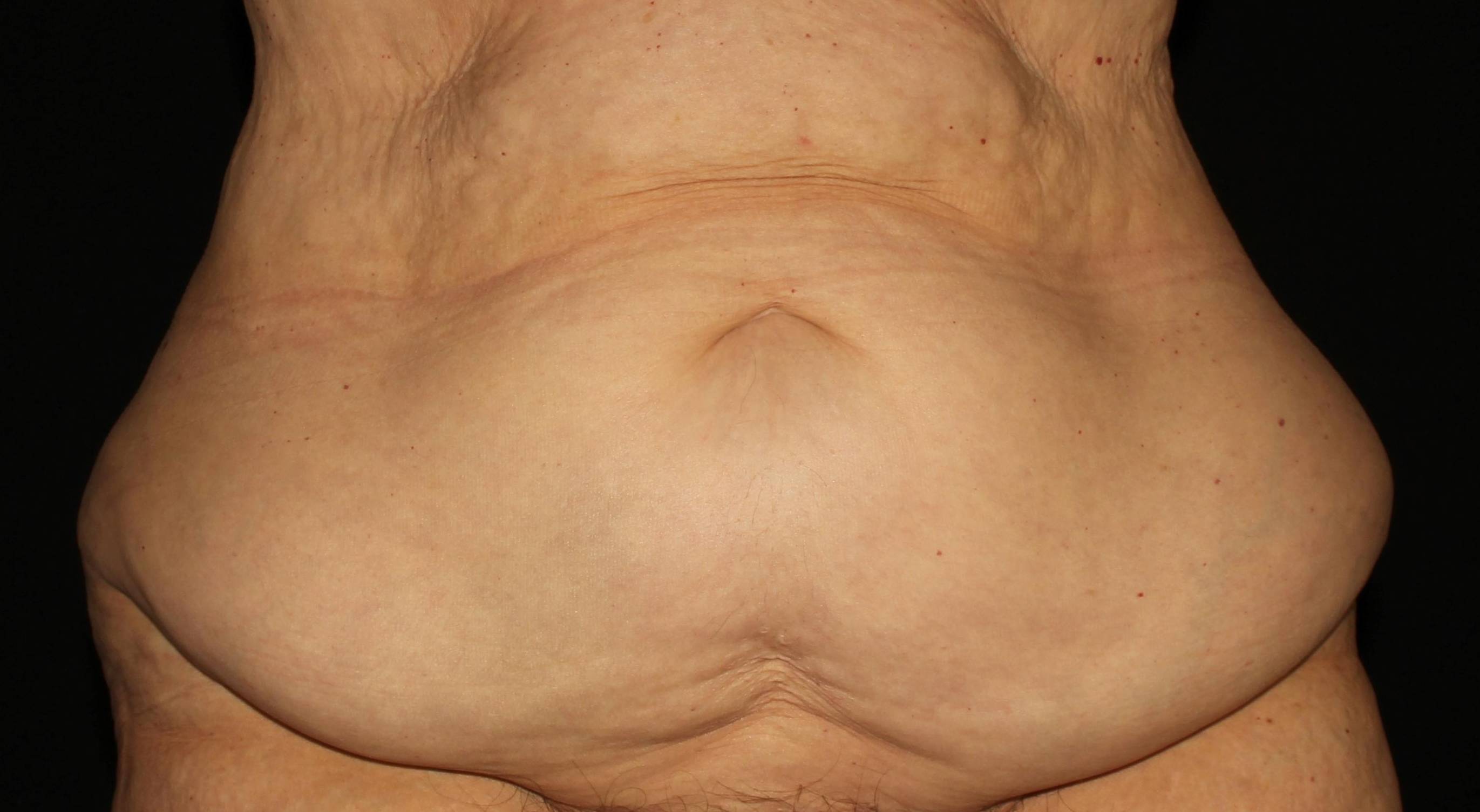 Abdominoplasty - Case #2 Before