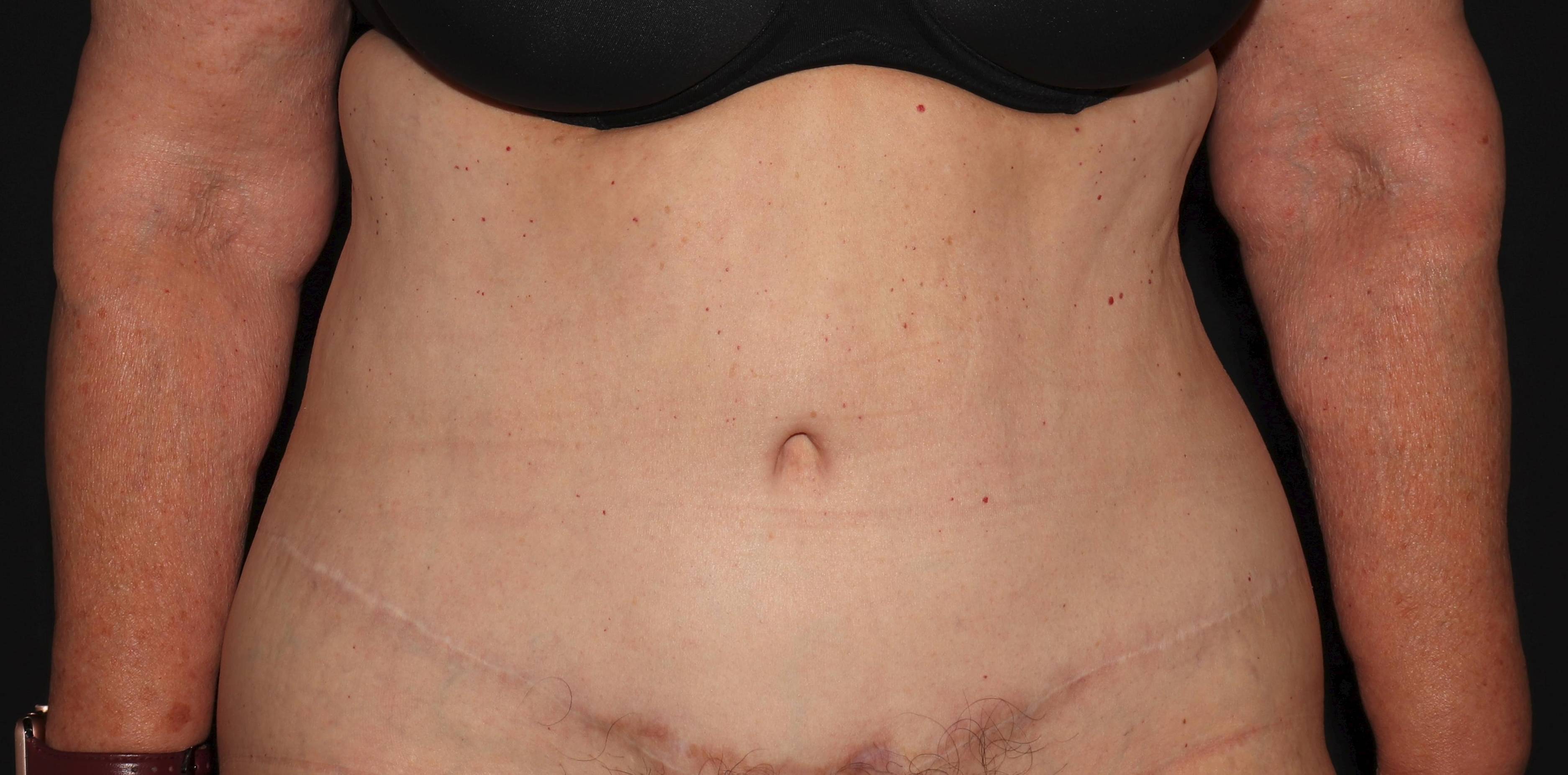 Abdominoplasty - Case #2 After