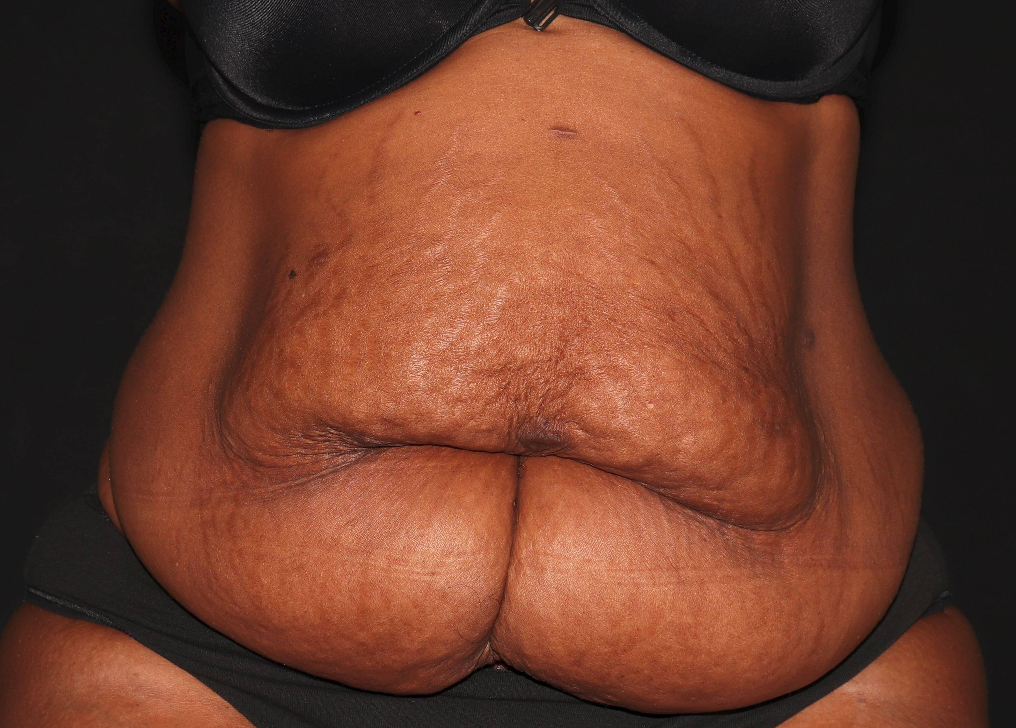 Abdominoplasty - Case #1 Before