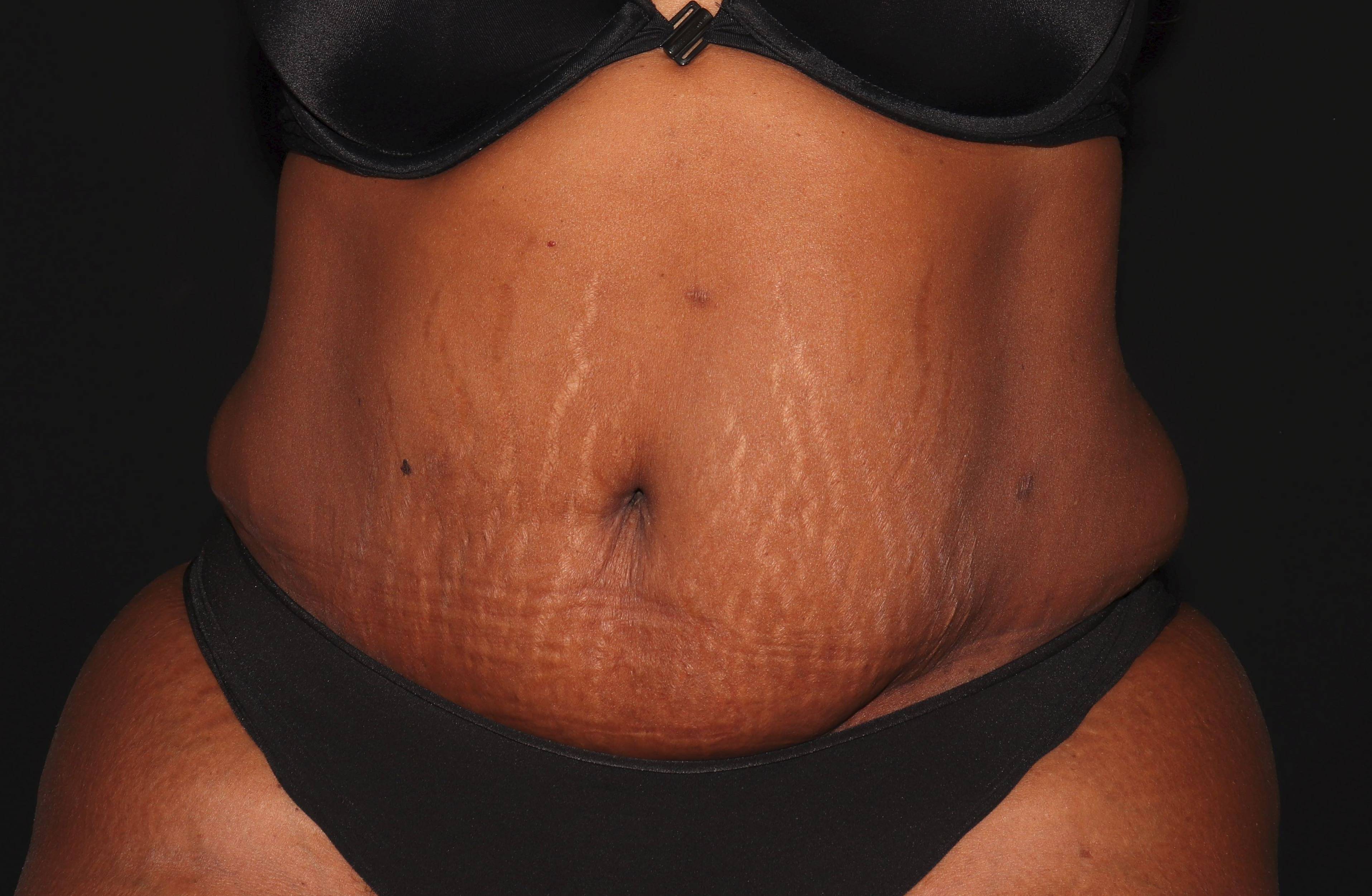 Abdominoplasty - Case #1 After