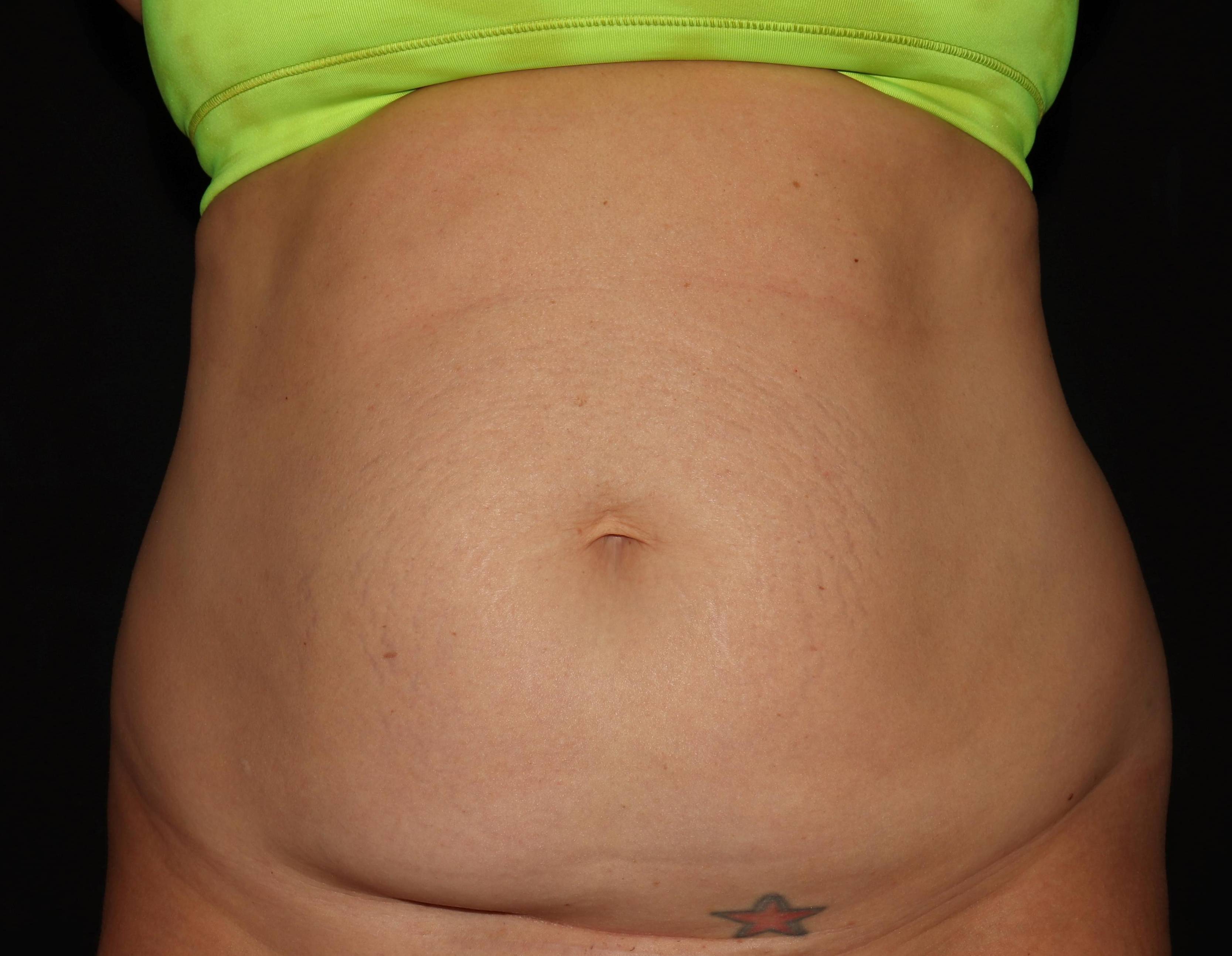 Abdominoplasty - Case #6 Before