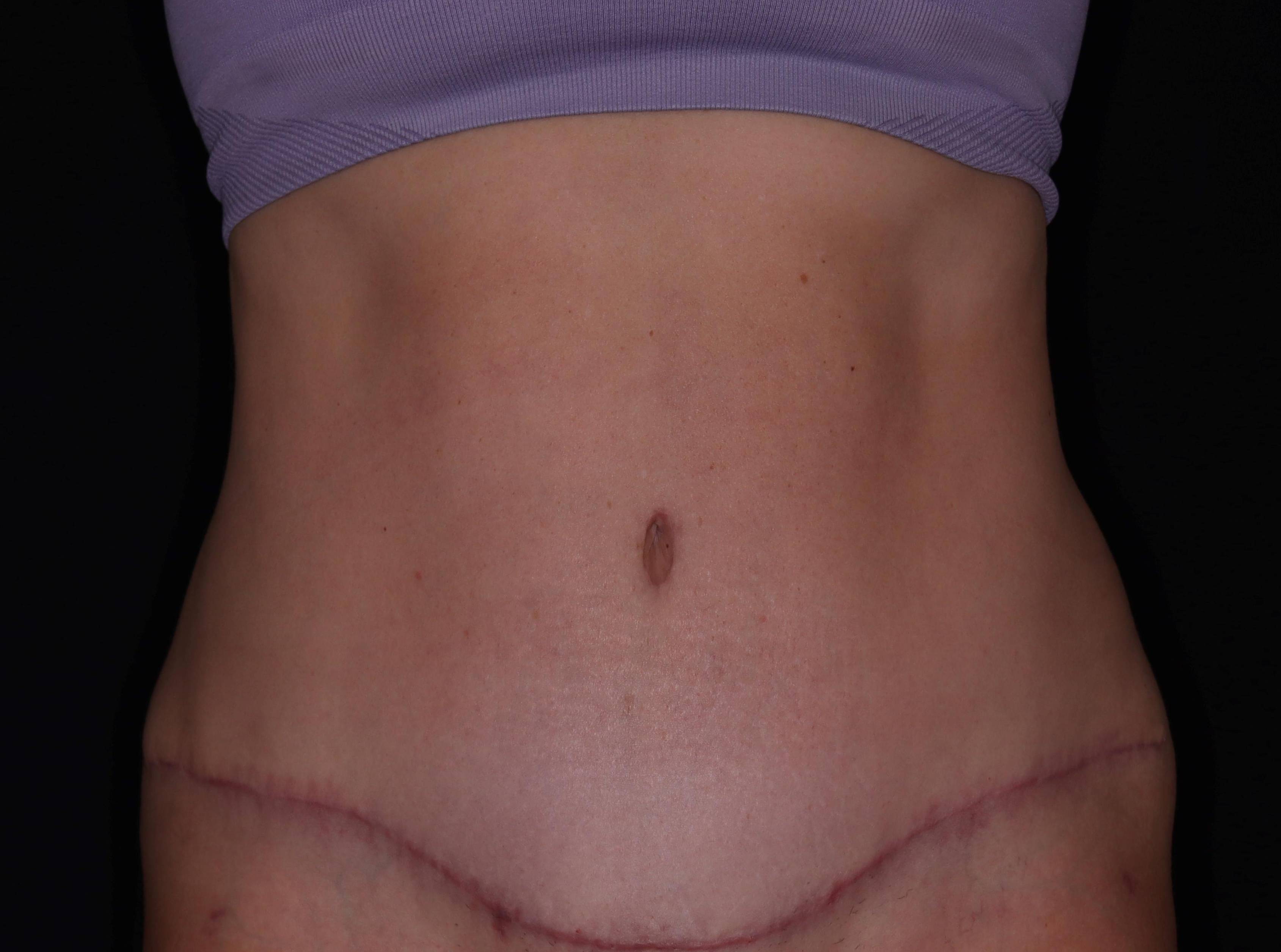 Abdominoplasty - Case #6 After