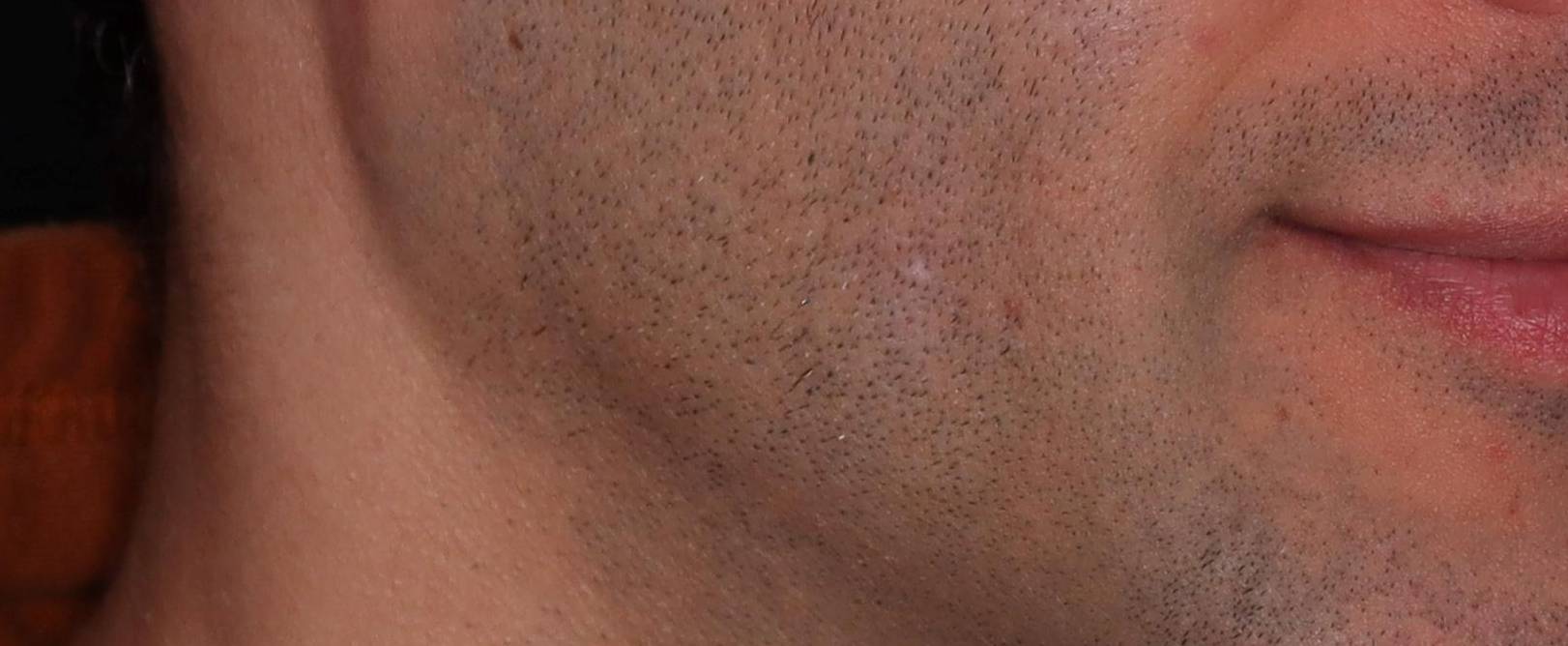 Genius Scar - Case #3 After