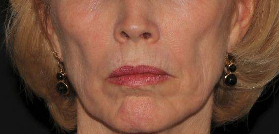 Filler Sculptra - Case #1 Before