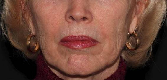 Filler Sculptra - Case #1 After