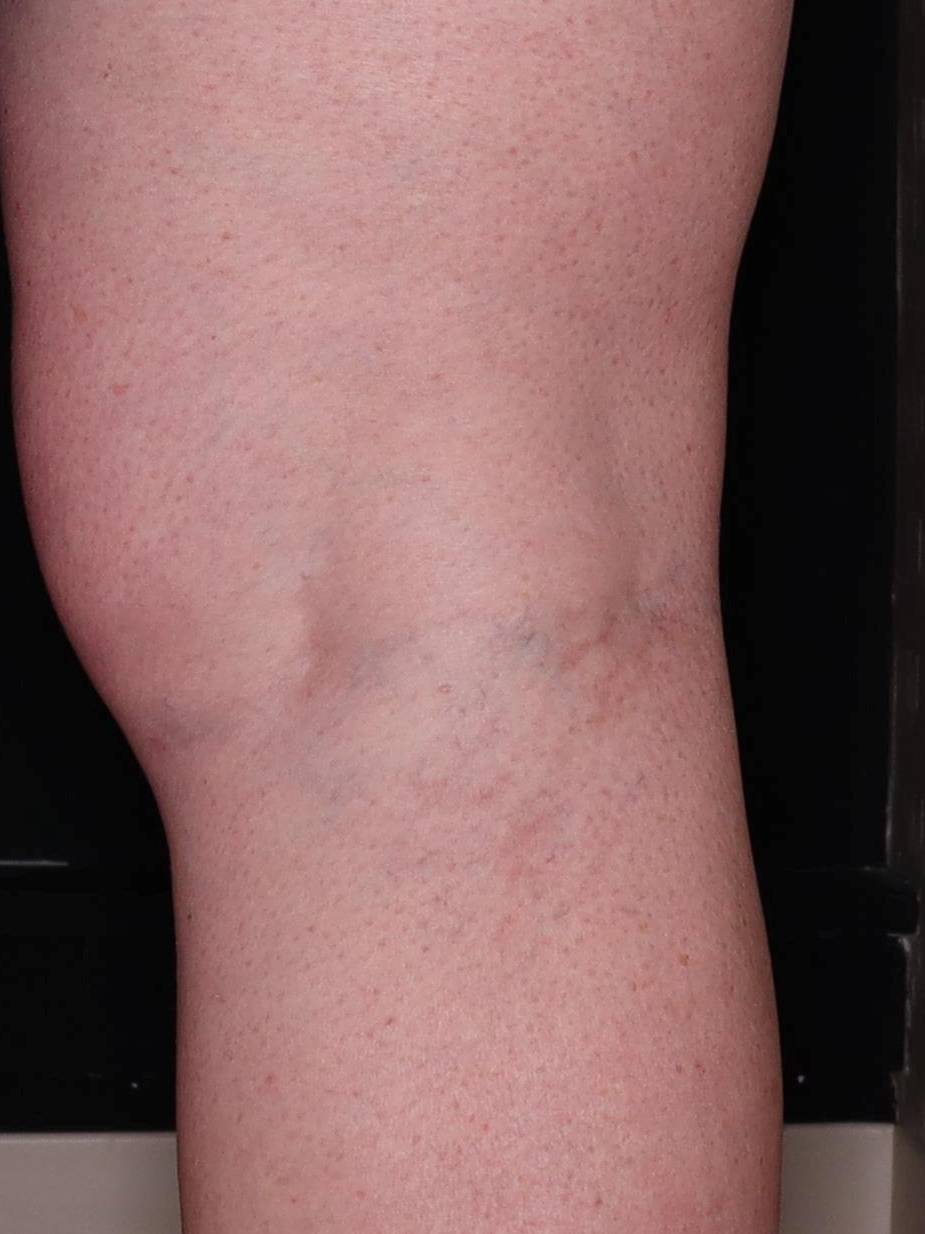 Asclera- Case #4 After