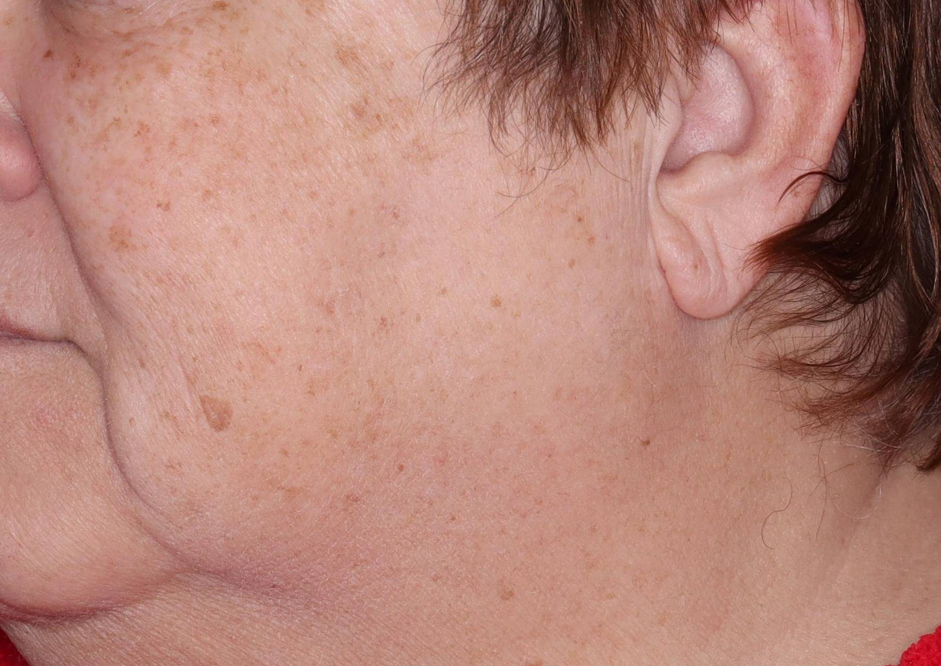 IPL Face- Case #15 Before