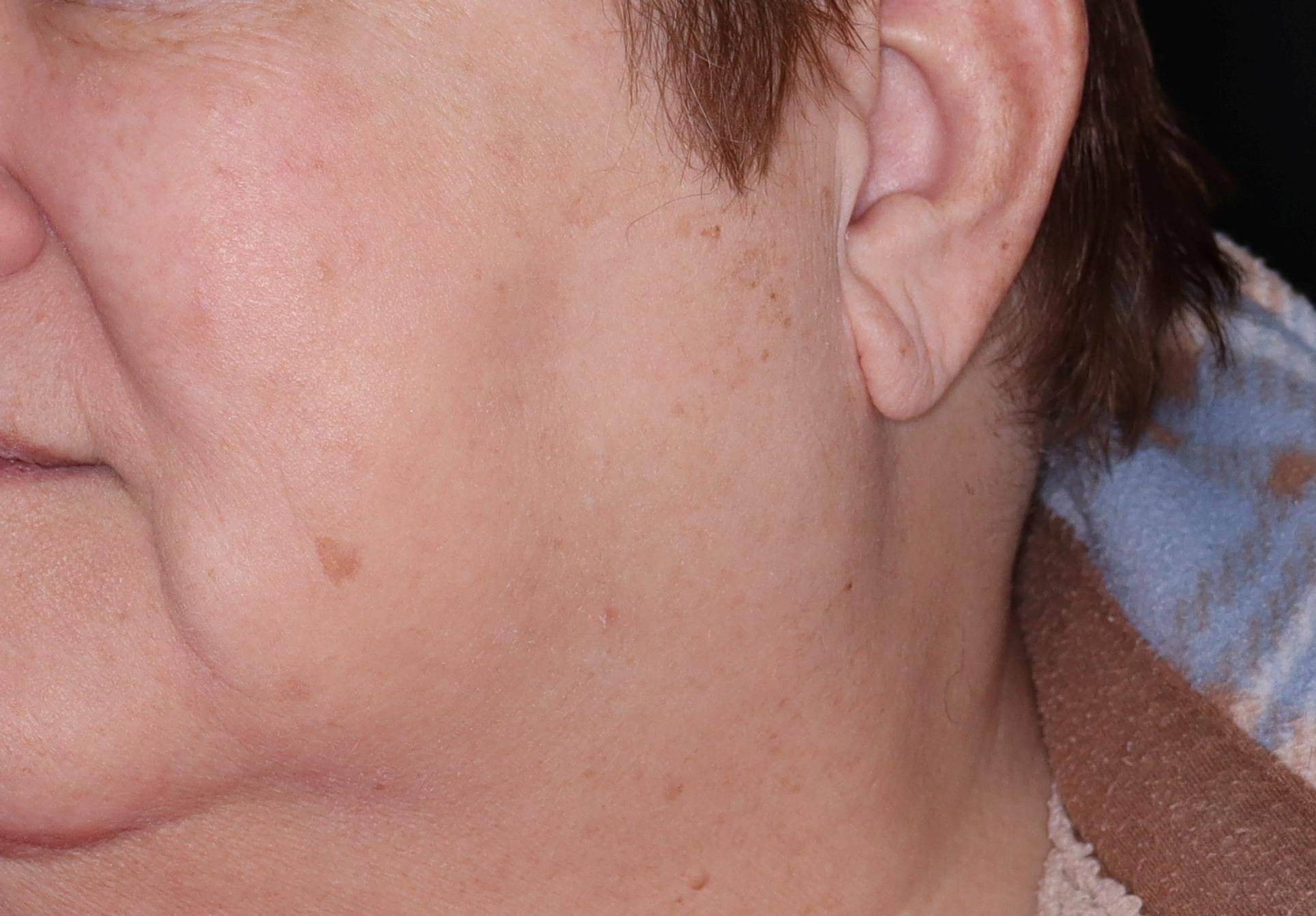 IPL Face- Case #15 After