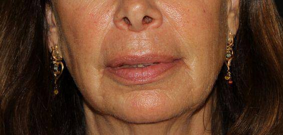 Filler Face - Case #1 Before