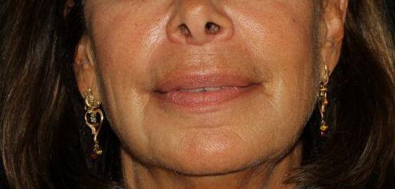 Filler Face - Case #1 After