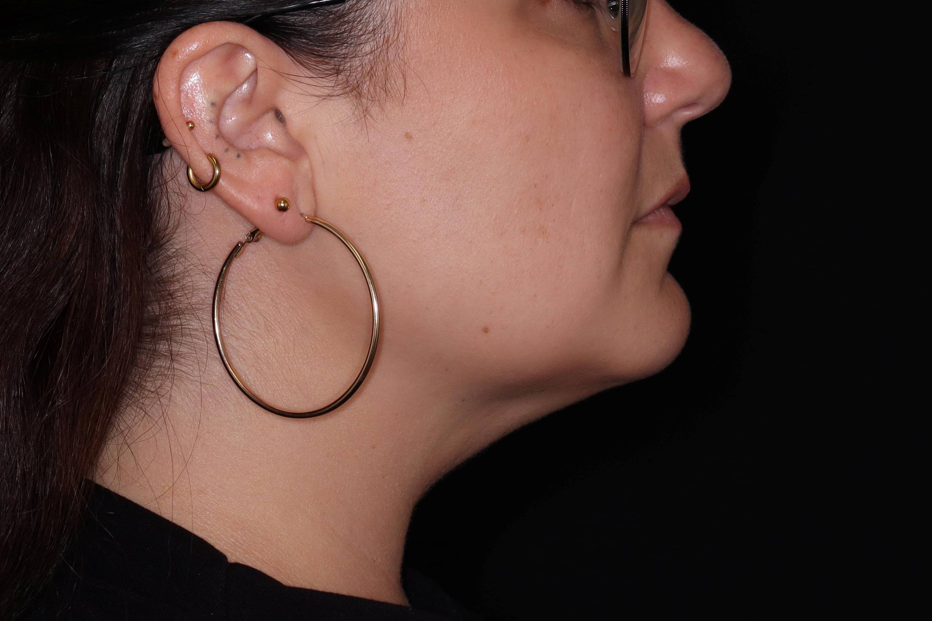 Kybella -Case #8 After