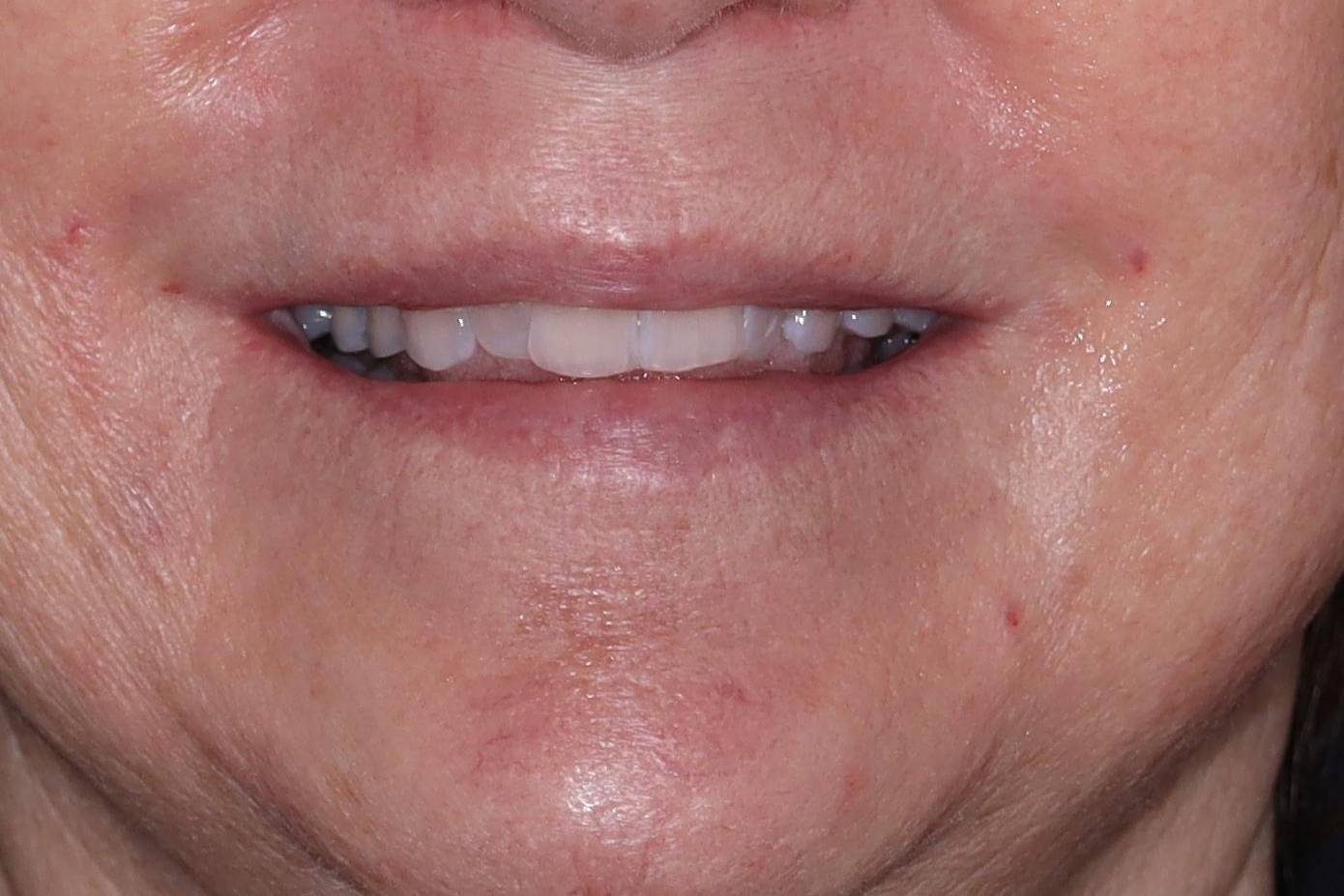 Filler-Case #2 After