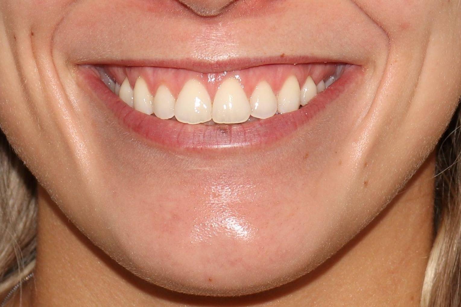 Filler Lips- Case #8 Before