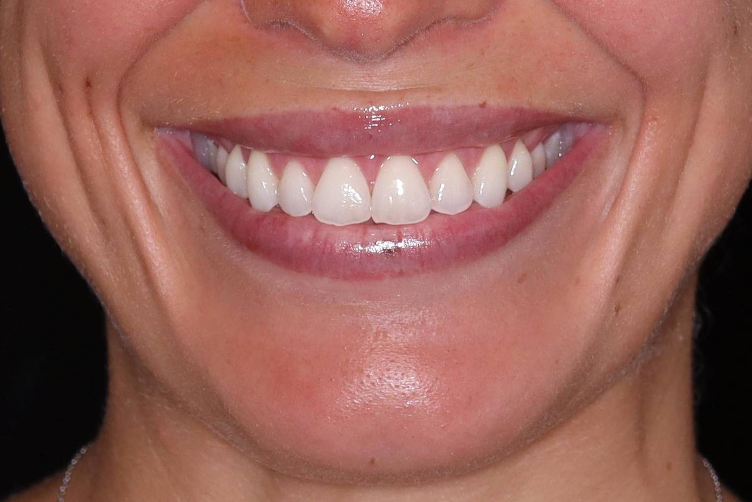 Filler Lips- Case #8 After