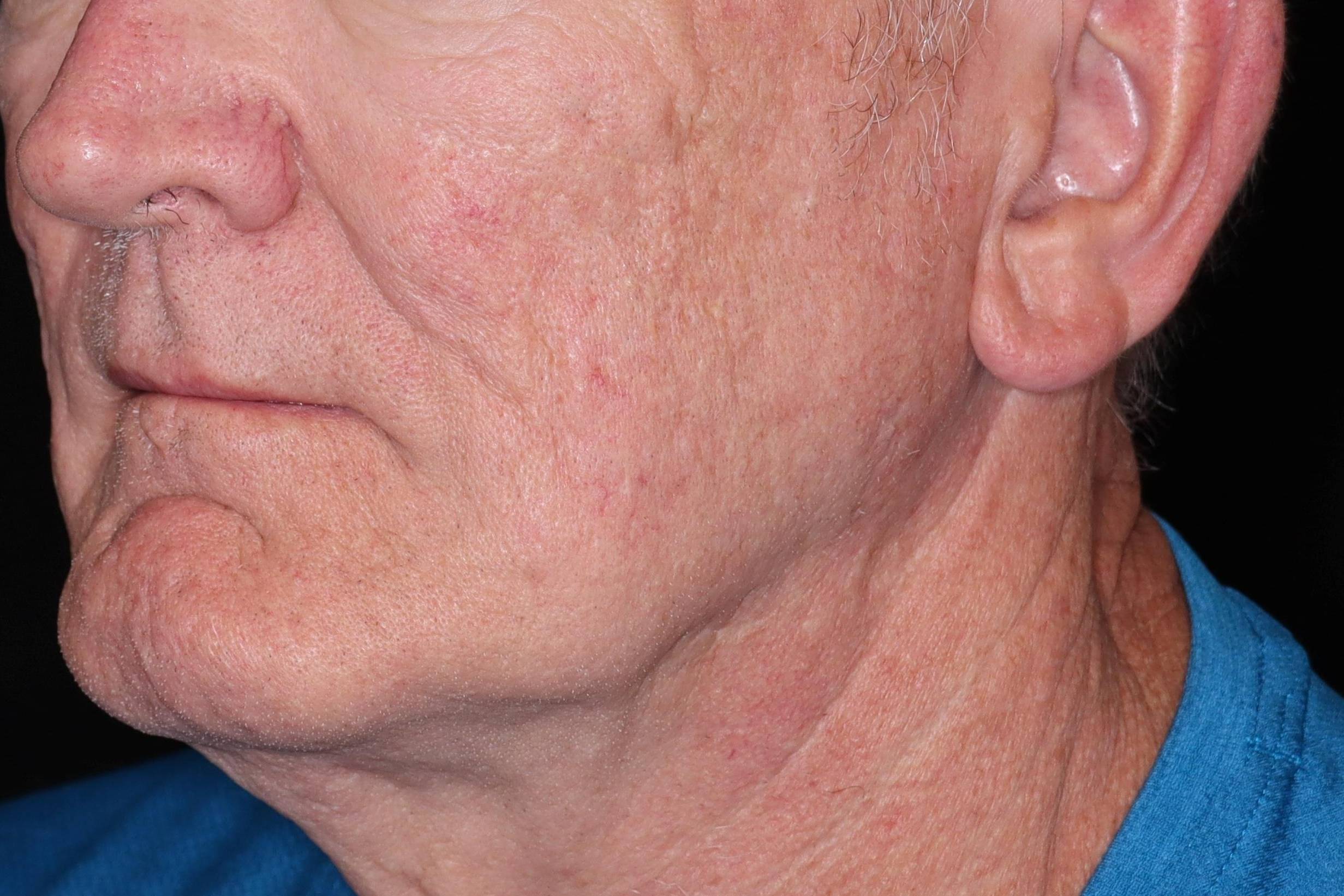 Filler Sculptra-Case #3 Before