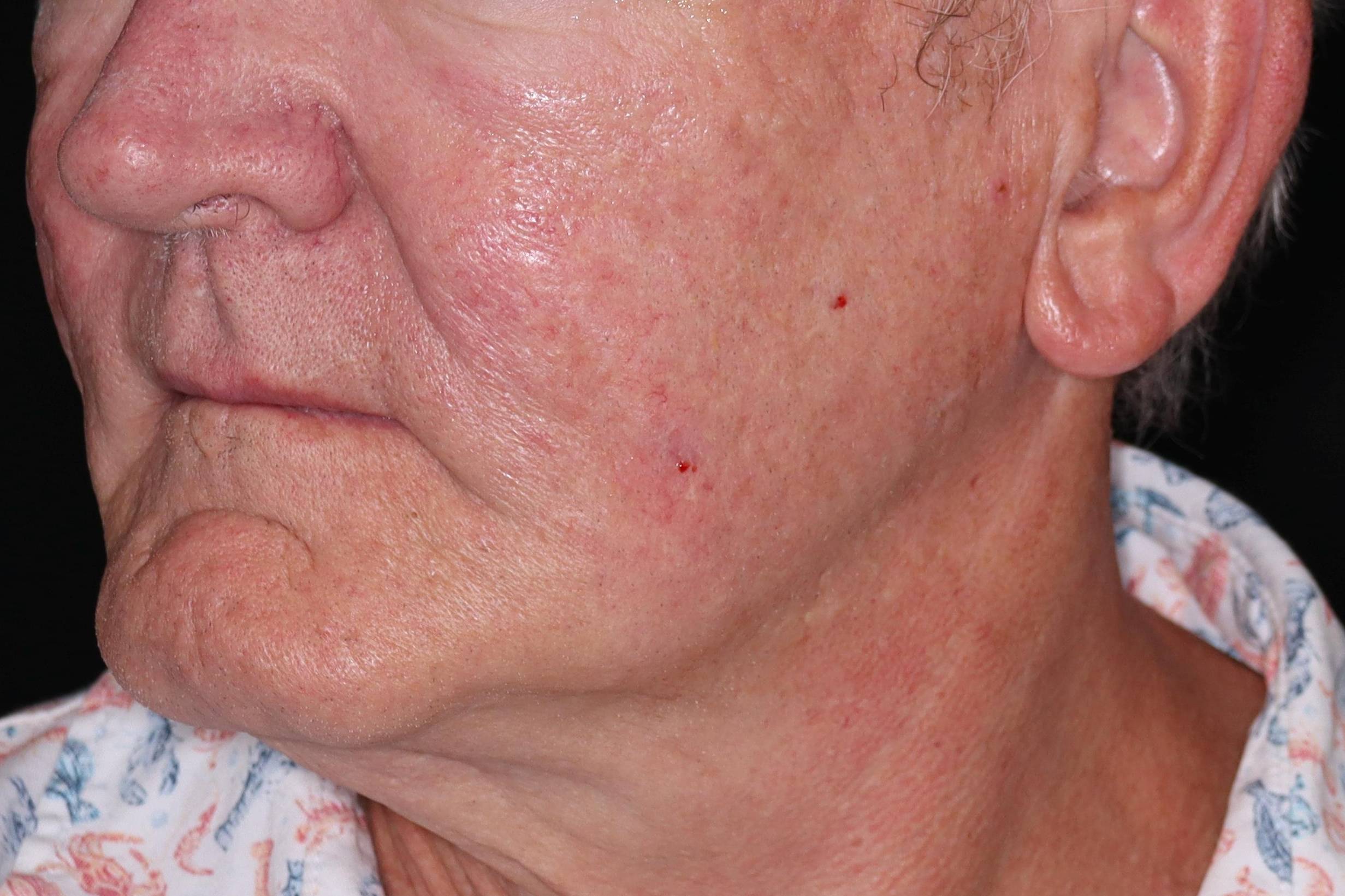 Filler Sculptra-Case #3 After