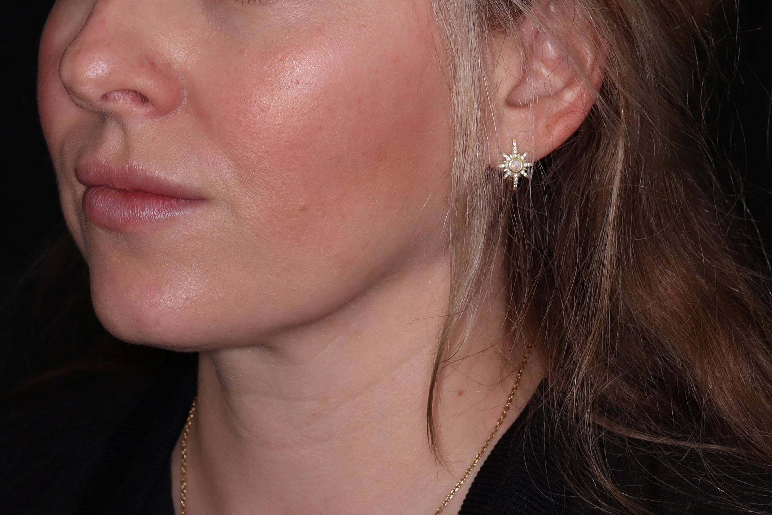 Filler-Case #3 Before