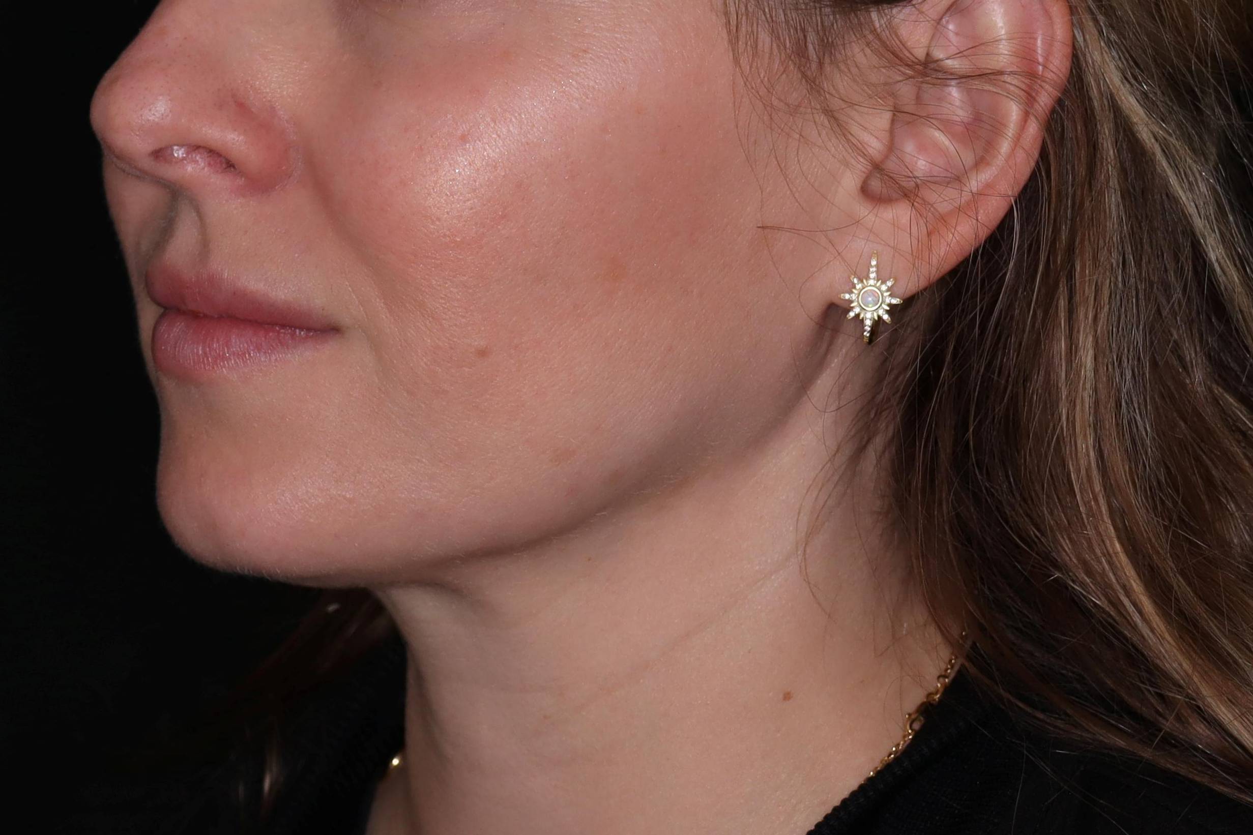 Filler-Case #3 After