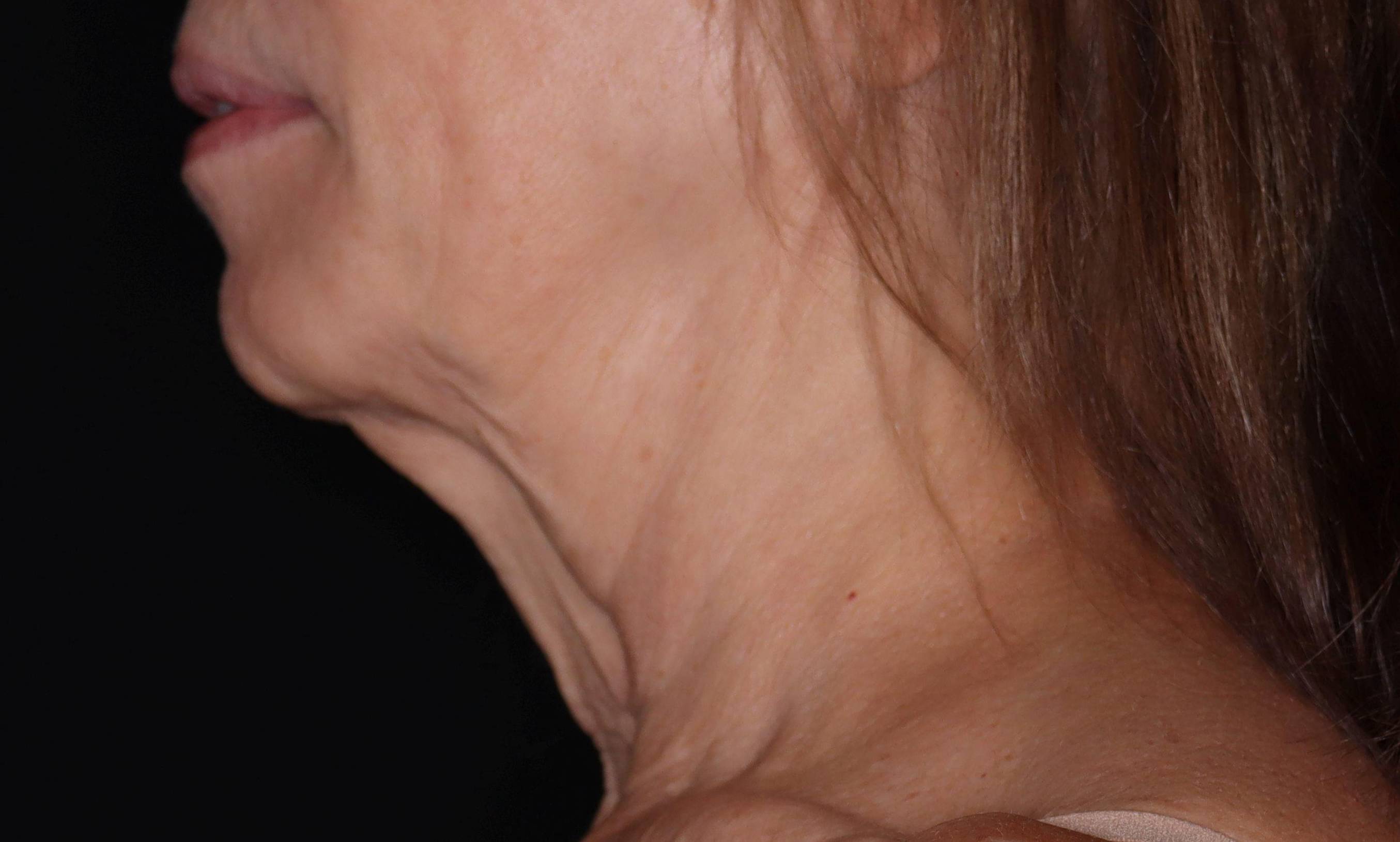 Radiesse-Case #2 Before