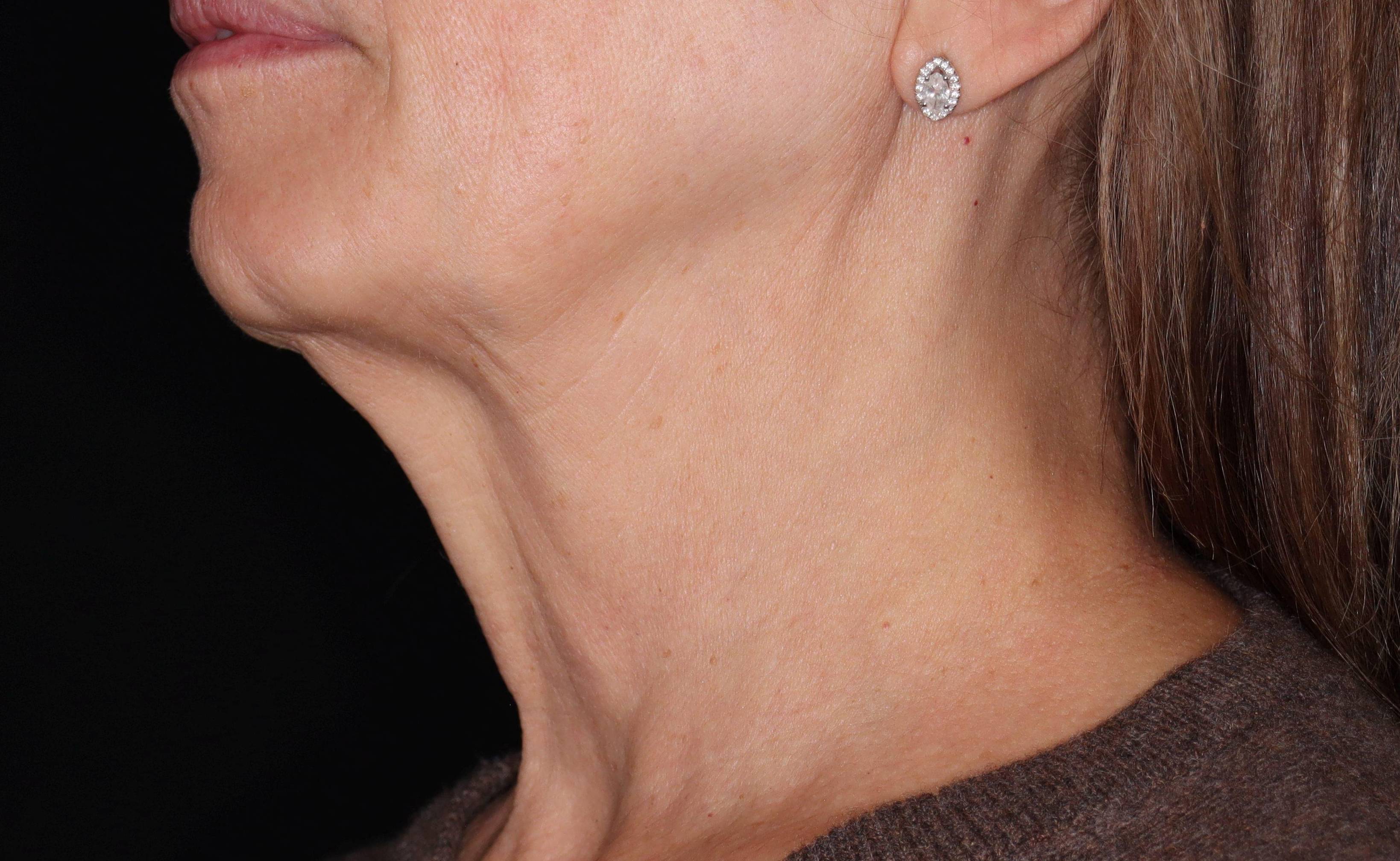 Radiesse-Case #2 After