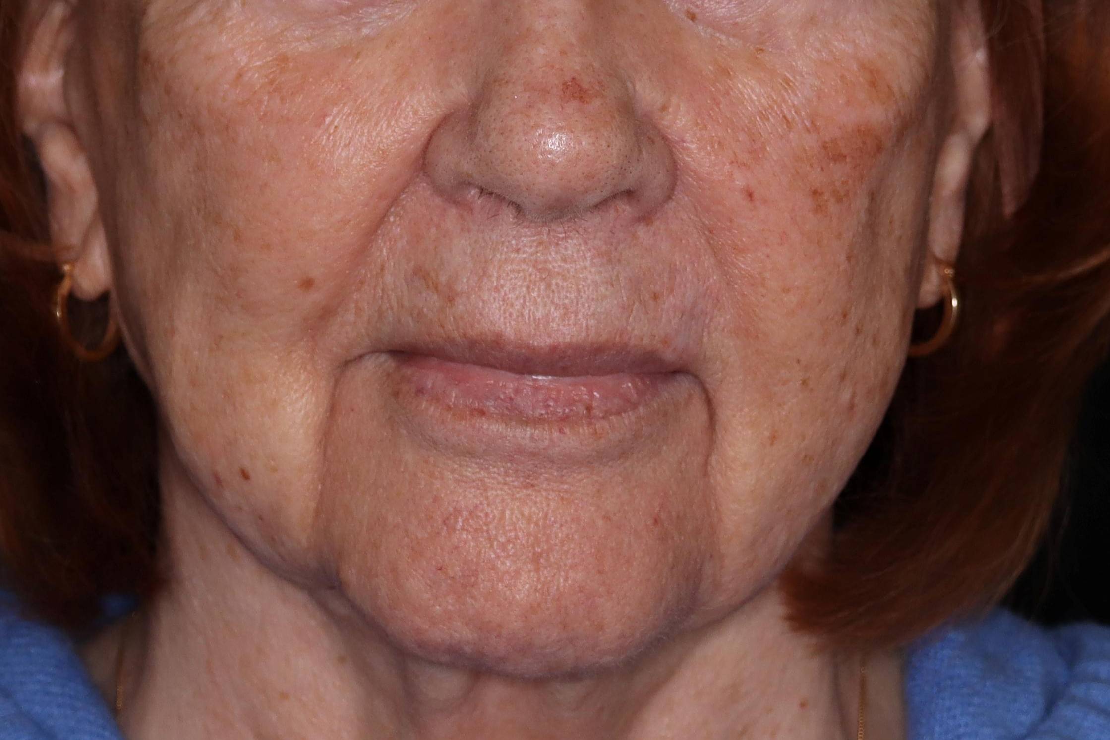 IPL-Case #17 Before IPL-Case #17 Before