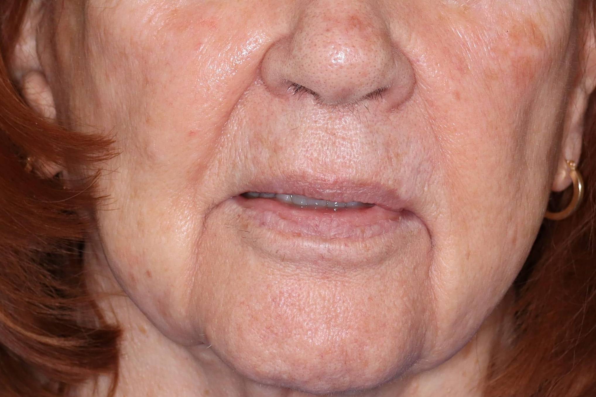 IPL-Case #17 After IPL-Case #17 After