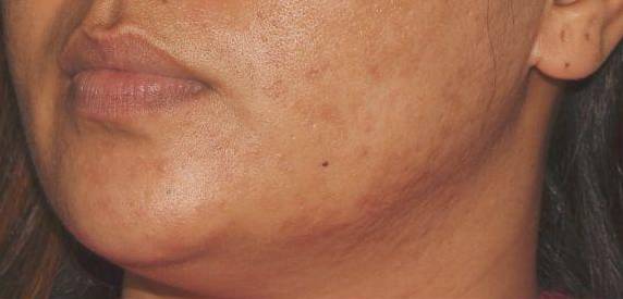 Genius Acne Scars - Case #7 Before